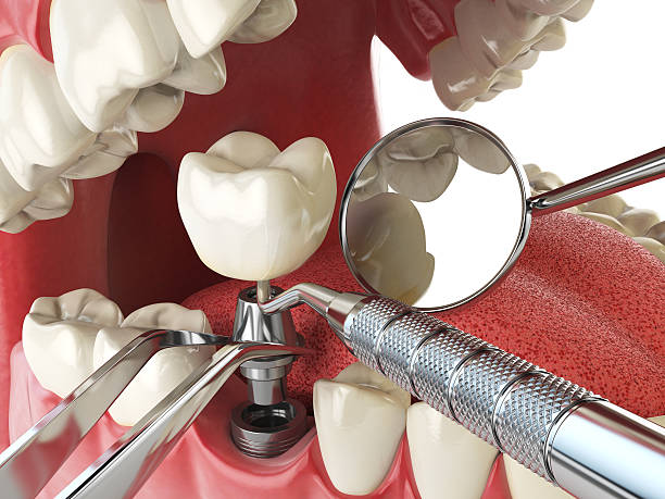 Best Emergency Dental Extractions in Sunnyvale, TX